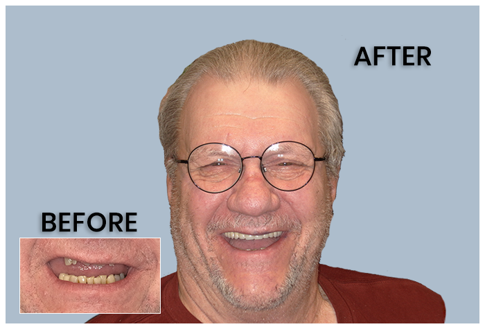 Overdentures Before and After George